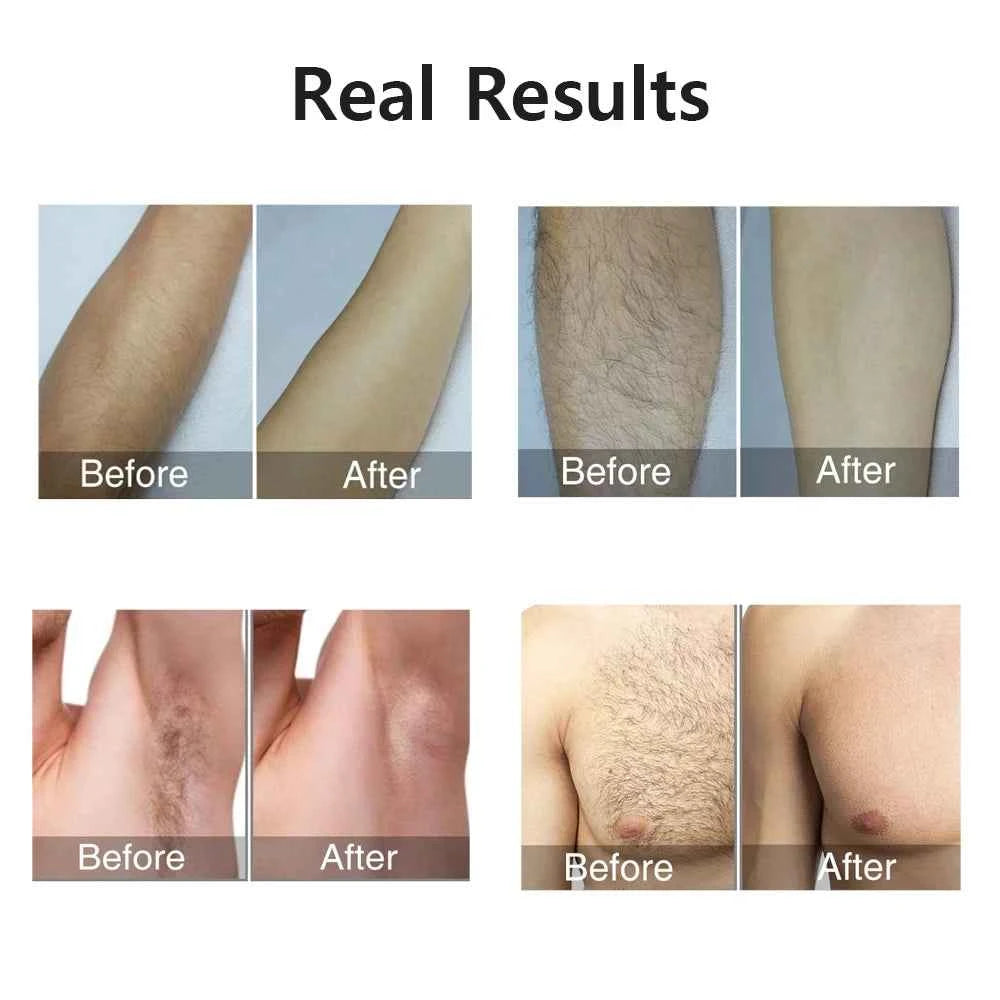 HOMEFISH Laser Epilator IPL Hair Removal For Women Body Bikini Facial 990000 Flashes Permanant Painless IPL Hair Remover Laser