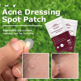 Acne Treatment Stickers For Deep Pimples | Invisible Acne Patches