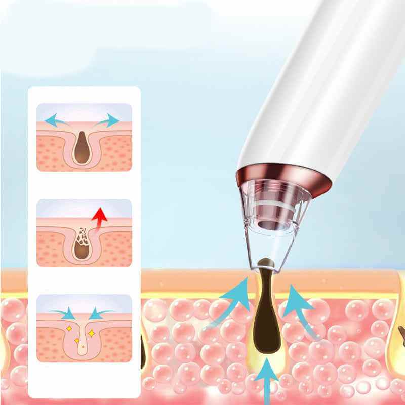 Electric Blackhead Cleansing Instrument | Electronic Blackhead Remover