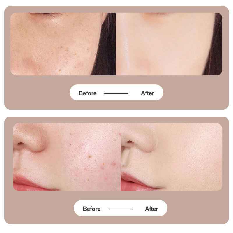 Tattoo Mole And Dark Spot Removal Plasma Pen | Skin Care Beauty Device